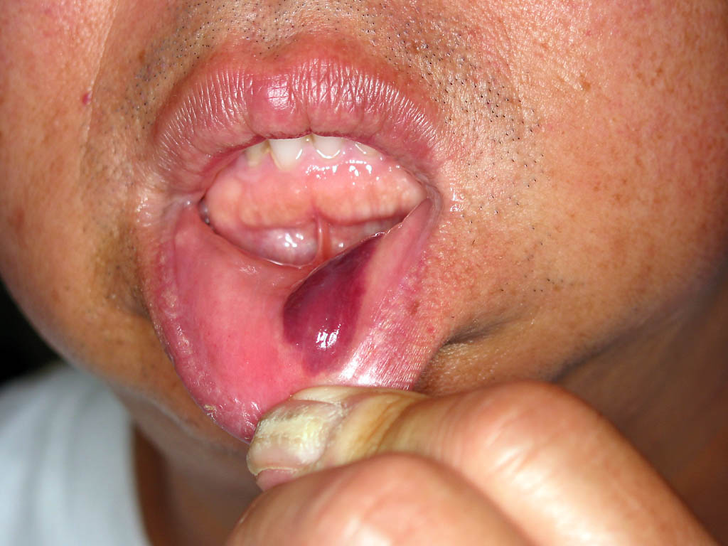 Puck bruise inside my lip
