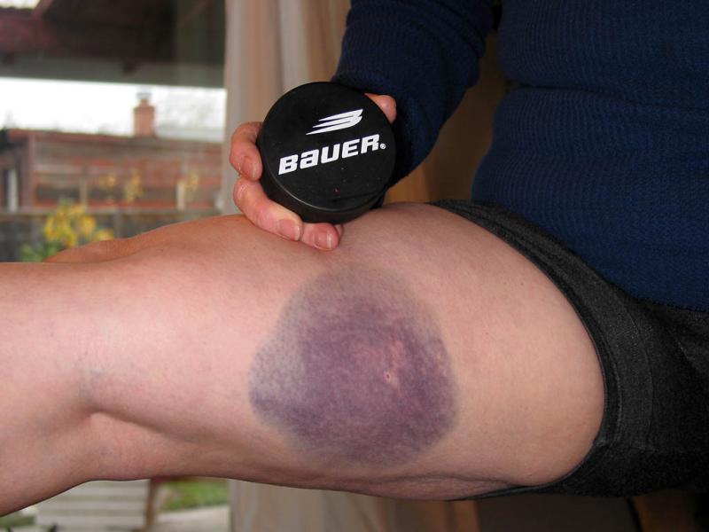 Puck bruise on Gail's inner thigh