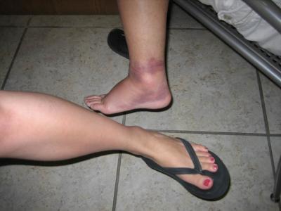 tina's normal ankle vs jerry's cankle