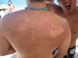 my sunburned back... yuck!