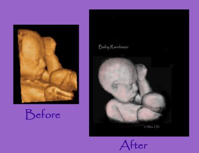 Baby Randazzo before and after