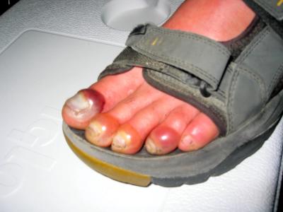 Ferg Hawke's toes after finishing in 2nd place.