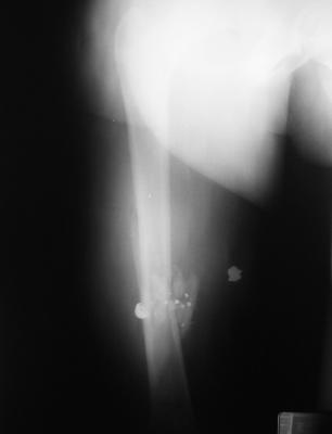 What a bullet does to bone